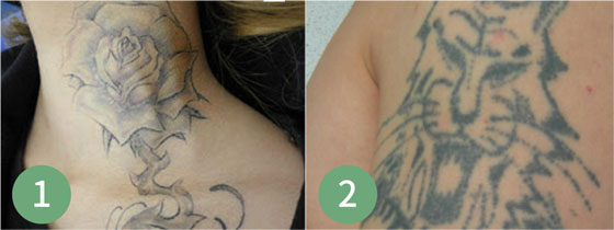 ピコレーザーの症例